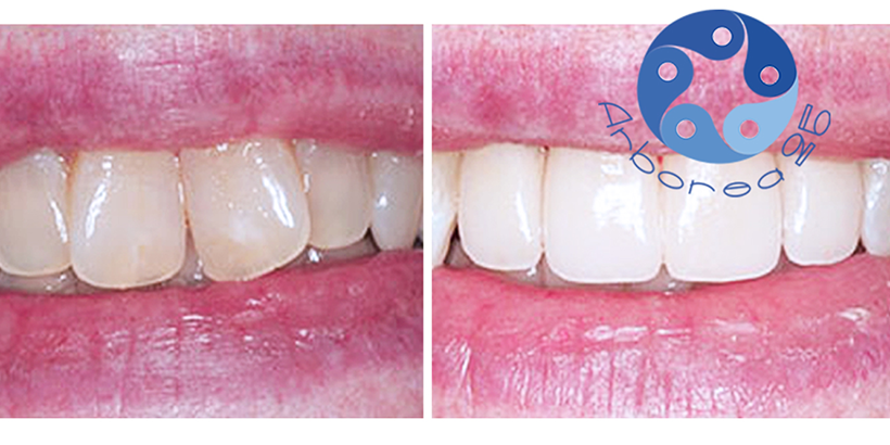 Faccette dentali, vantaggi e curiosità per un sorriso perfetto - Arborea25