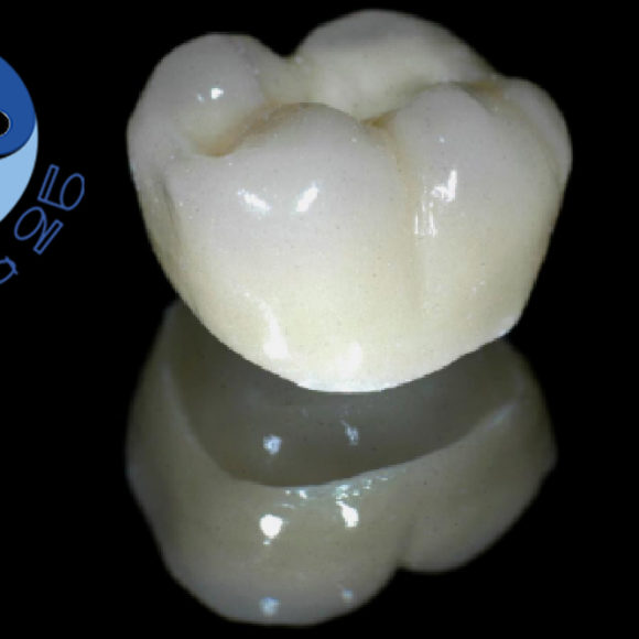Cosa si intende per corona dentale in ceramica integrale?