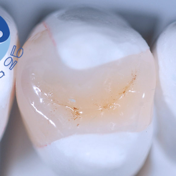 Intarsio dentale. Quando viene utilizzato e perché?